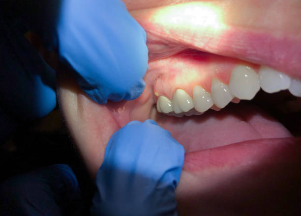 Best Dental Abscess Treatment in Tenaha, TX
